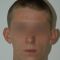 Ear surgery (Otoplasty)