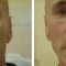 Liquid facelift