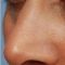 Operácia nosa (Rhinoplastika)