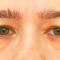 Operácia očných viečok (Blepharoplastika)