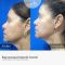 Rejuvenecimiento facial con láser fraccionado