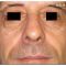 Injections d