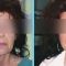 Facelift, Lifting twarzy (podciąganie powłok twarzy)