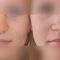 Rhinoplasty (Nose Job)