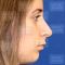 Operácia nosa (Rhinoplastika)