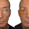 Facelift, SMAS facelifting