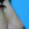 Plastika nosu (Rhinoplastika)