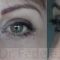 Operácia očných viečok (Blepharoplastika)