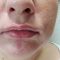 Teosyal, Restylane, Esthelis, Juverdem, Surgiderm (preparáty kyseliny hyaluronovej)