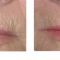 Fotorejuvenizácia /Resurfacing