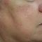 Procedure laser in dermatologia estetica