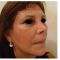 Facelift, SMAS Facelift