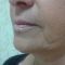 Liquid facelift