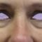 Eyelid surgery (Blepharoplasty)