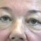 Eyelid surgery (Blepharoplasty)