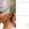Facelift, SMAS facelifting