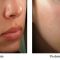 Radiofrekvenční rejuvenace - vyhlazení pleti (ShapeUp!, Aluma, Accent, TriPollar, Spa RF, Radiofrequency Re-Styling, Re-Age, Pellevé)