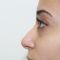 Rhinoplastie médicale