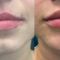Hyaluronic acid-based wrinkle fillers