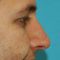 Plastika nosu (Rhinoplastika)