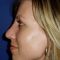 Plastika nosu (Rhinoplastika)