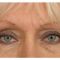 BOTOX®