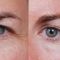 Operácia očných viečok (Blepharoplastika)