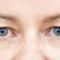 Operácia očných viečok (Blepharoplastika)