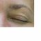Eyelid surgery (Blepharoplasty)