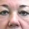 Eyelid surgery (Blepharoplasty)