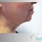 Facelift, SMAS facelifting