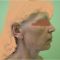 Facelift