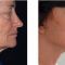 Lifting du visage