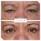 Blépharoplastie