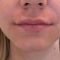 Lippenvergrößerung mit Hyaluronsäure