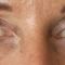 Nichtchirurgische Faltenbehandlung - BOTOX® / DYSPORT®