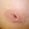 Inverted nipples