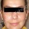 Cirugía de la nariz (Rinoplastia)