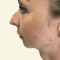 Lipofilling, Lipografting, Lipotransfer (přenos a aplikace vlastního tuku)