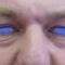Eyelid surgery (Blepharoplasty)