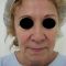 Facelift, SMAS facelifting