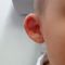 Otoplastie (Chirurgie esthétique des oreilles)