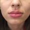 Lip augmentation - cheiloplasty