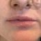Lippenvergrößerung