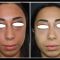 Injections d