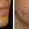 Lipofilling (grasso)