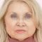 Facelift, SMAS facelifting