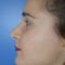 Rhinoplastie