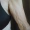 Microneedling (Dermaroller)