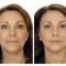 Restylane®